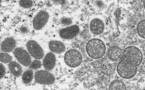 全球出現3.5萬猴痘病例：單周暴增20% 已波及92個國家